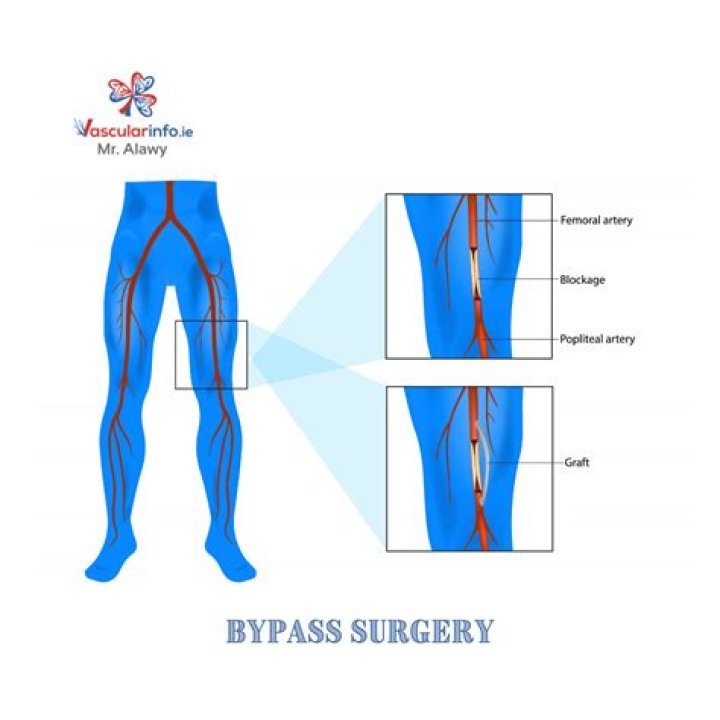 What does a micro bypass do