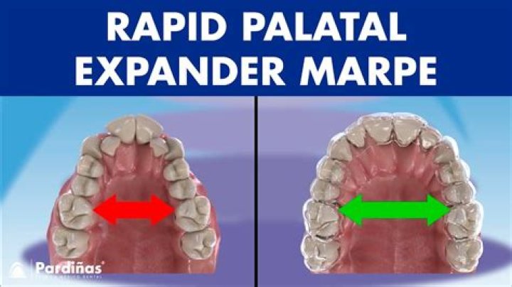 What does a palatal lift do