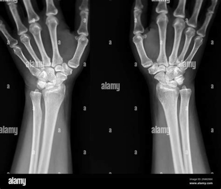 What does an arm X Ray Show