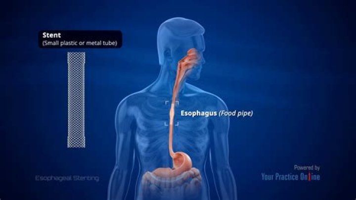 What does an Esophagram diagnose