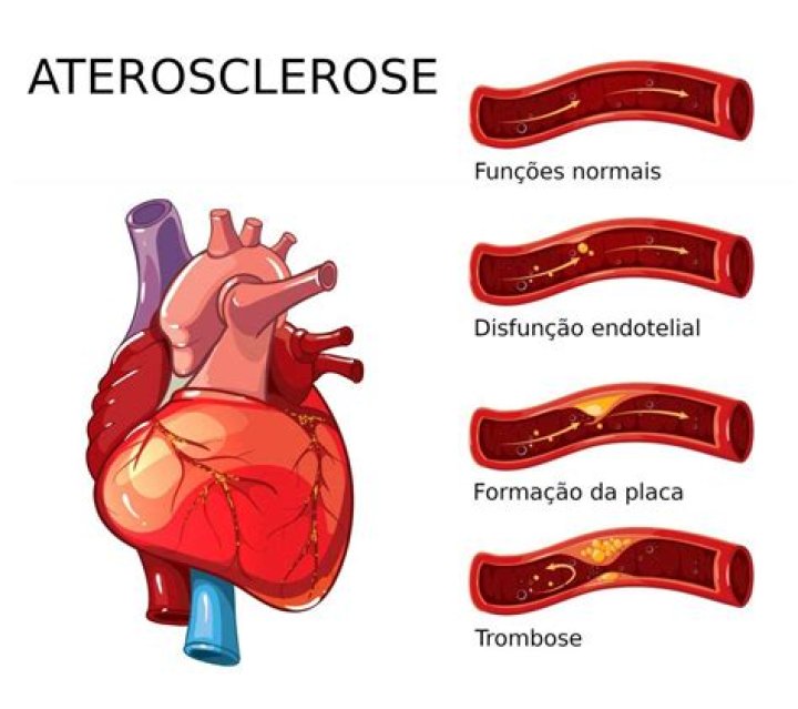 What does Angiosclerosis mean