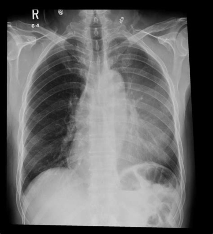 What does atelectasis mean on chest xray
