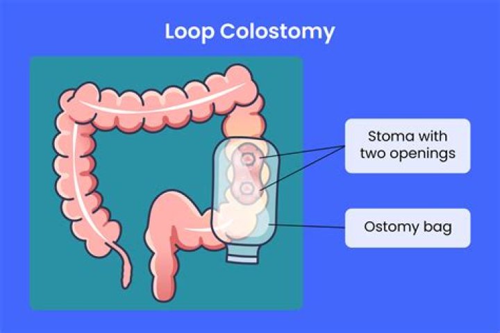 What does colostomy status mean