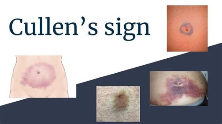 What does Cullens sign mean