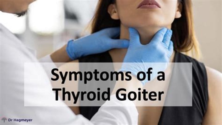 What does diffuse goiter mean