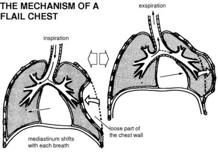 What does flail chest mean