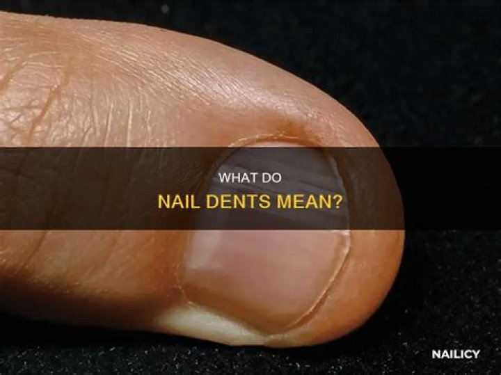What does it mean when you have dents in your nails