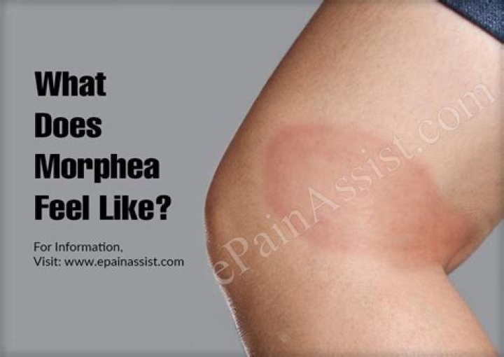 What does Morphea feel like