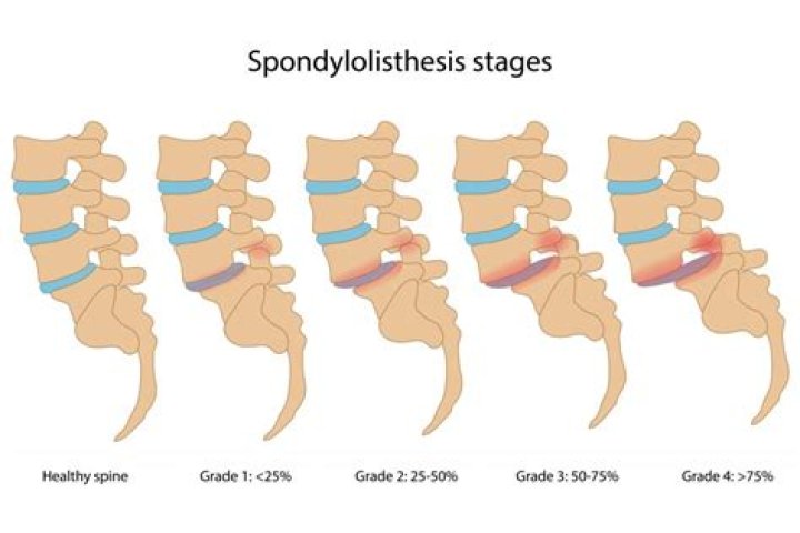 What does no Listhesis mean