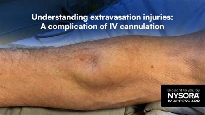 What happens when an IV is put in wrong