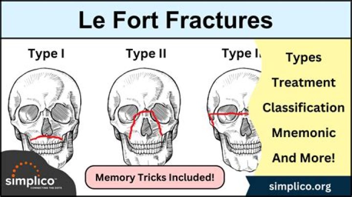 What is a Lefort 4 fracture