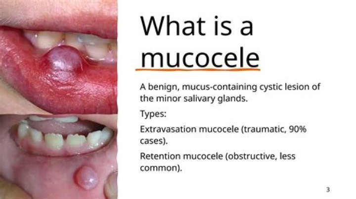 What is a Mucocele in mouth
