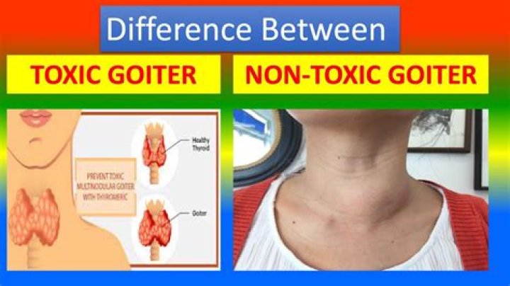 What is a non-toxic goiter