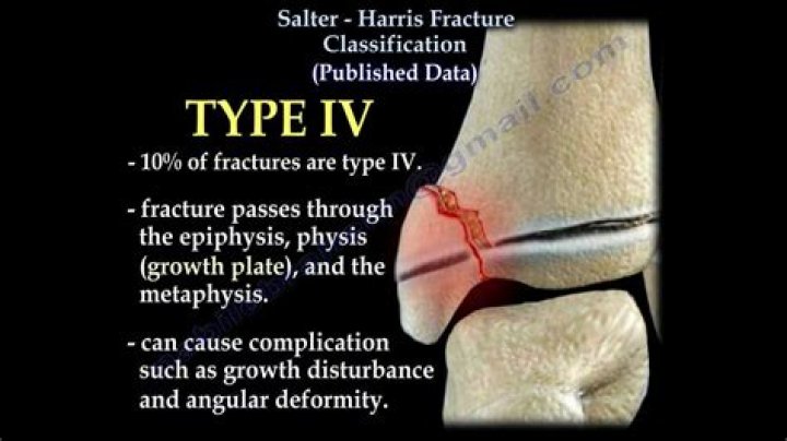WHAT IS A Salter 1 fracture