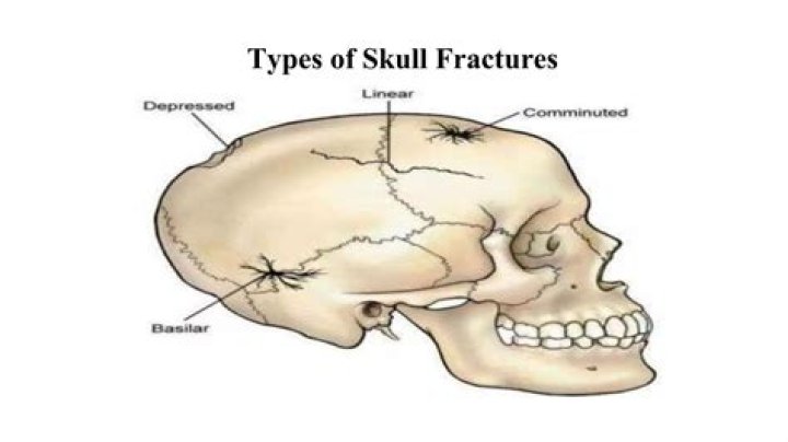 What is a skull fracture