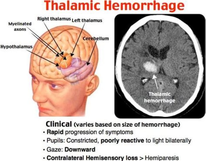 What is a thalamic hemorrhage