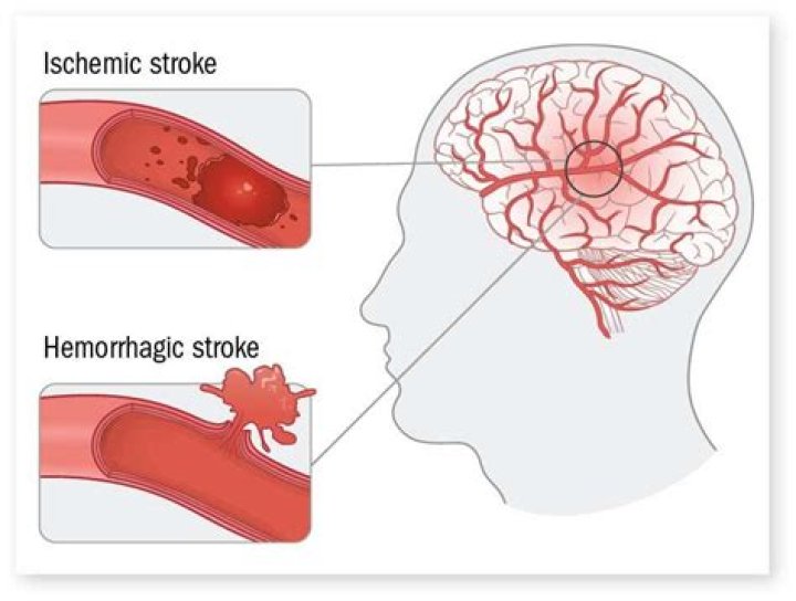 What is a thrombotic stroke