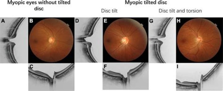 What is a tilted optic disc