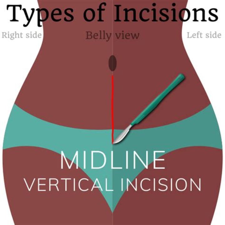 What is a vertical incision