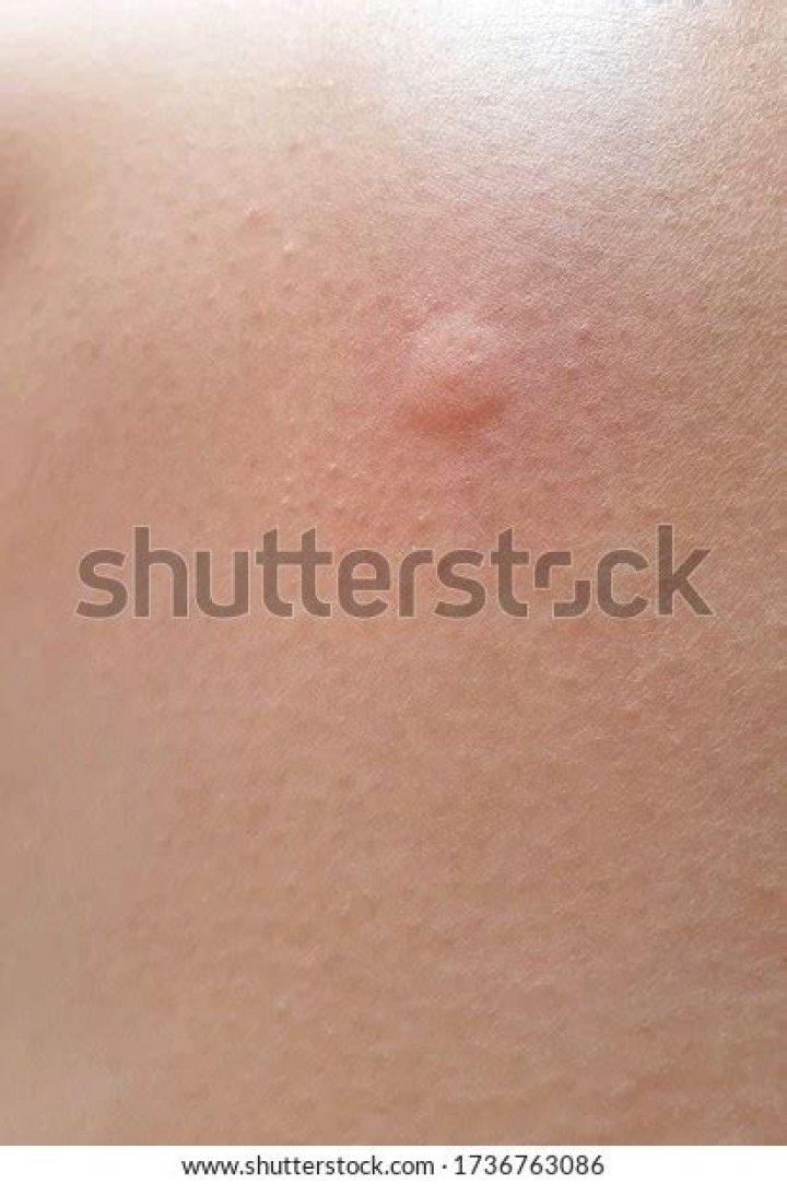 What is a wheal on the skin