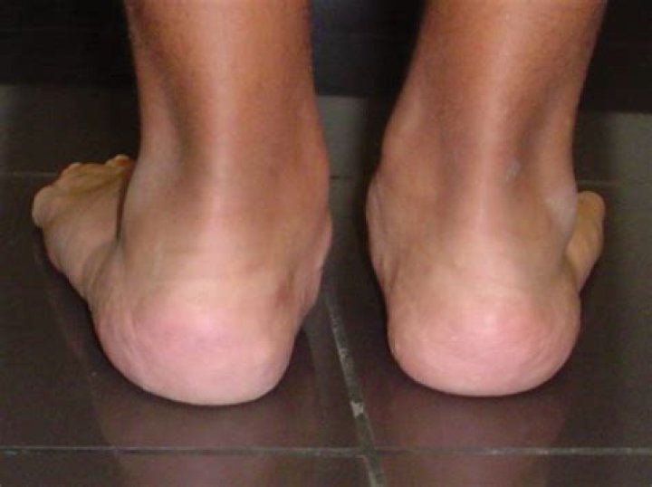 What is acquired deformity