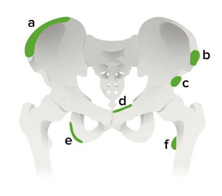 What is an Apophyseal fracture