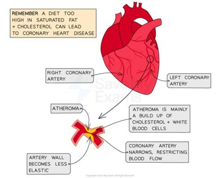 What is an atheroma made of