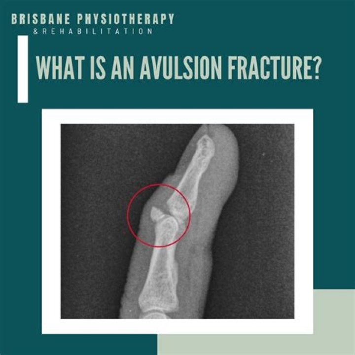 What is an avulsion injury