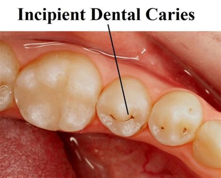 What is an incipient lesion