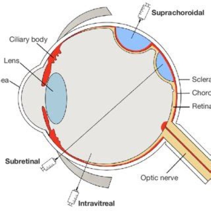 What is an intraocular disk