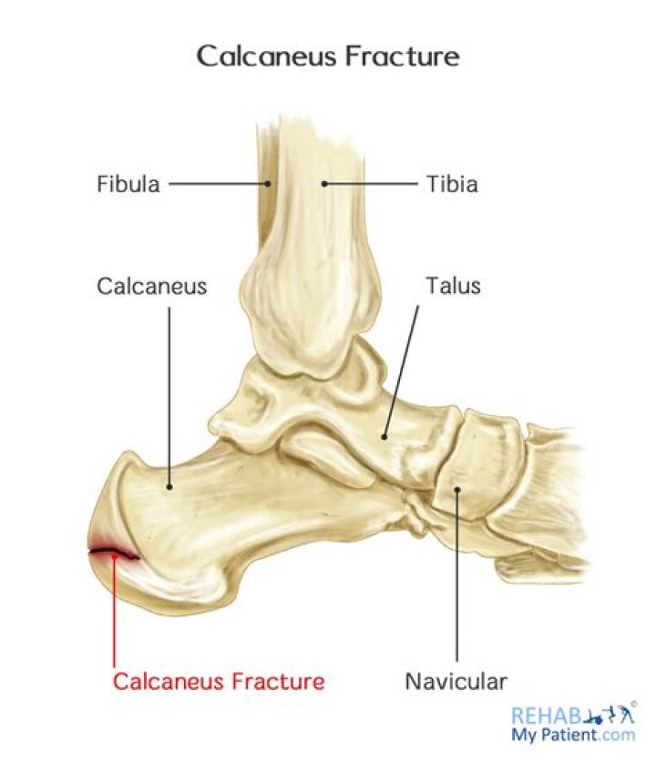 What is calcaneal fracture