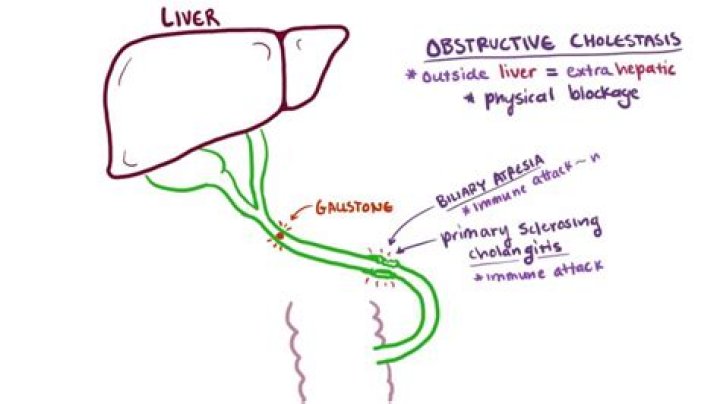 What is cholestatic pattern