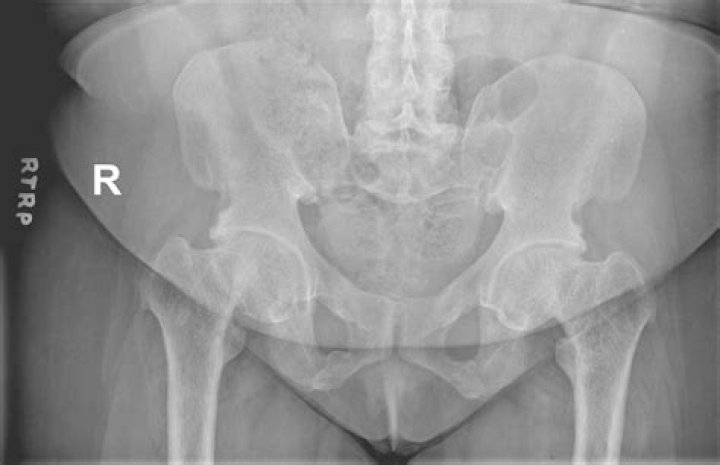 What is coxa vara deformity