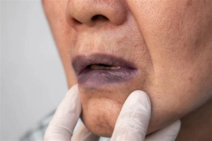 What is cyanosis caused by