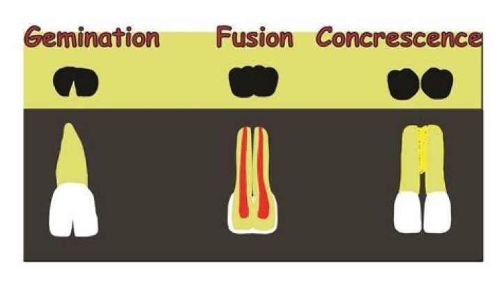 What is dental Concrescence
