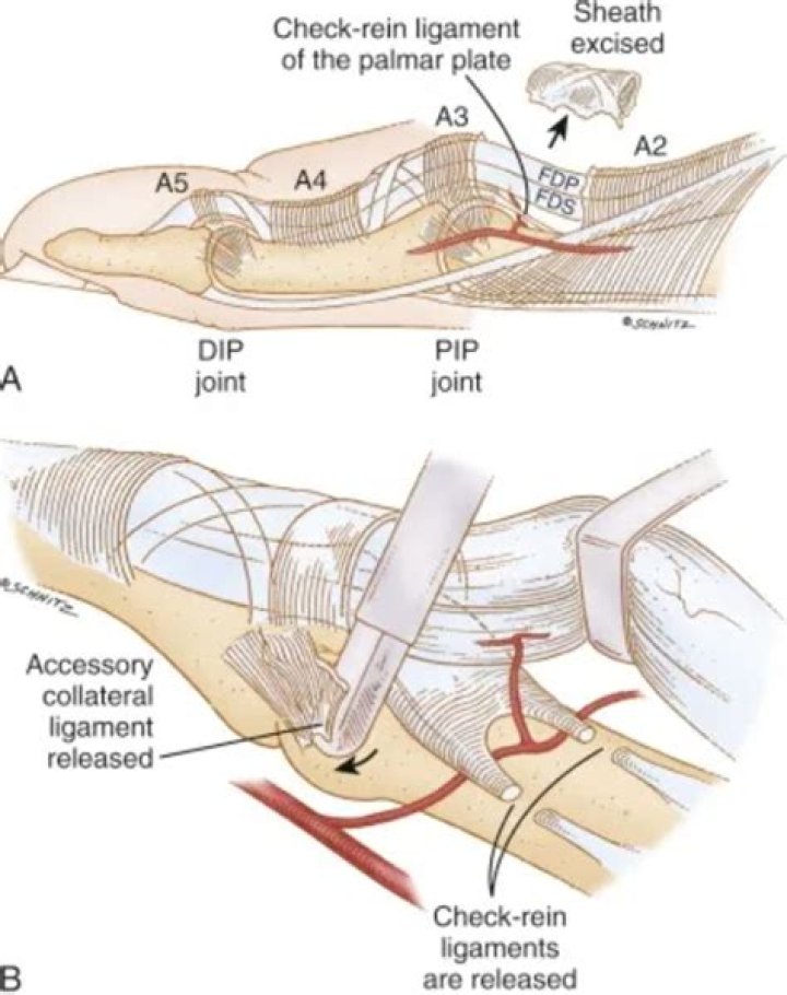 What is dorsal capsulotomy
