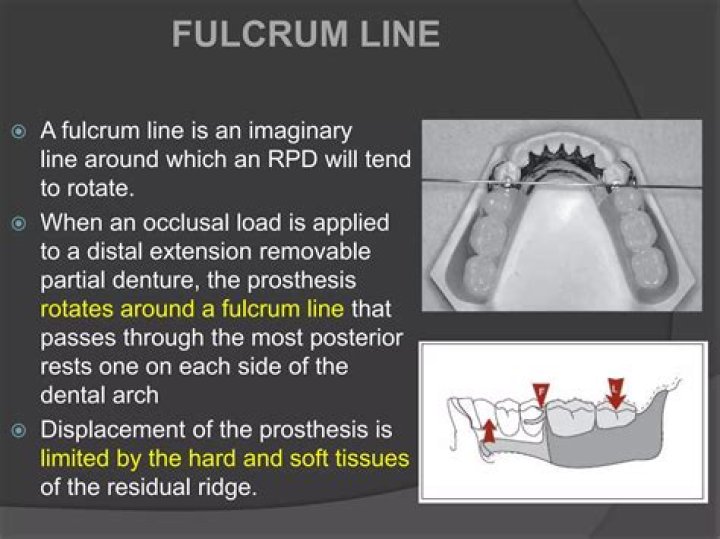 What is Fulcrum line in RPD
