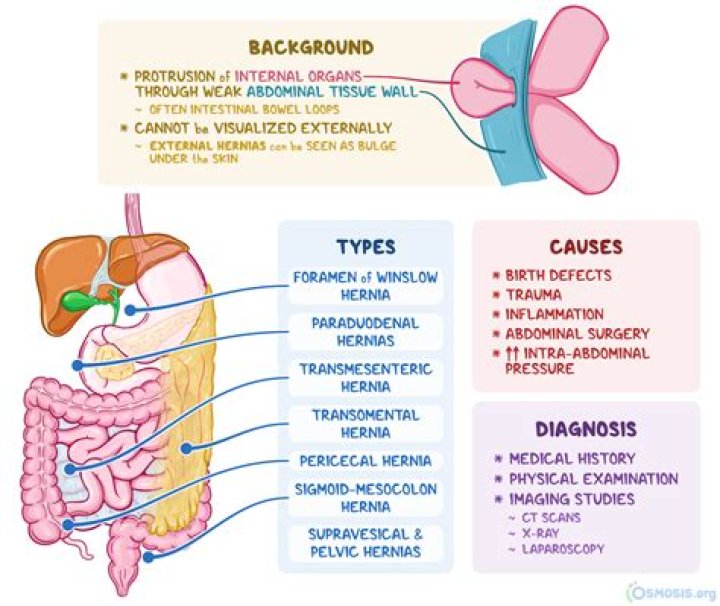 What is interstitial hernia