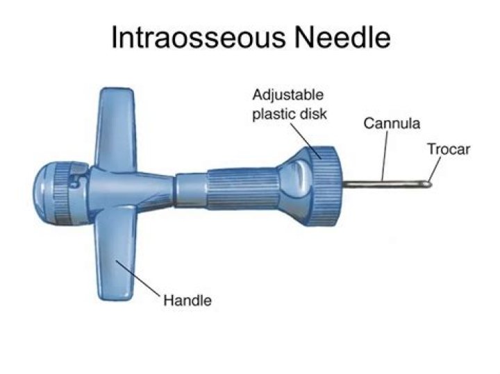 What is intraosseous needle