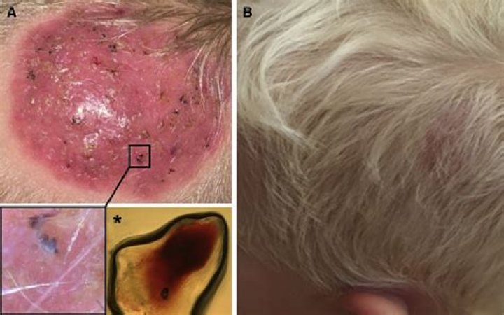 What is kerion of the scalp