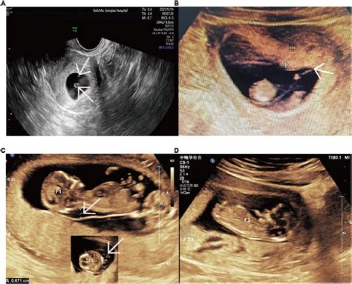 What is meant by fetal demise