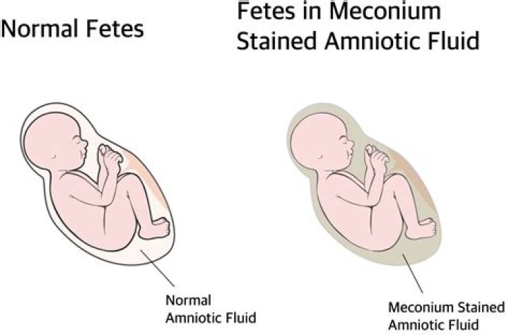 What is meconium aspiration