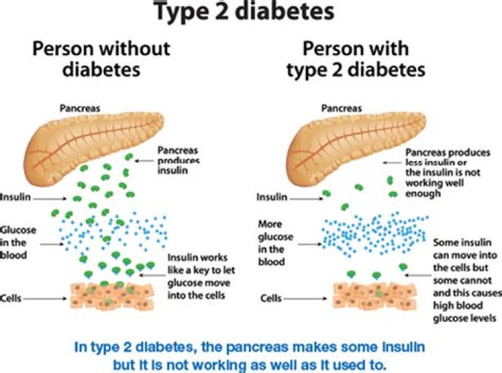 What is pancreatic diabetes