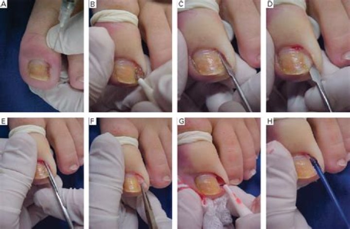 What is phenol Matricectomy