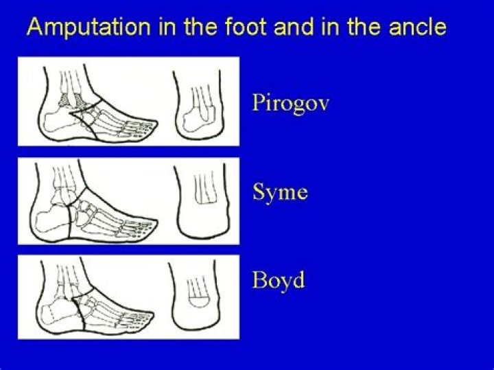What is pirogoff amputation