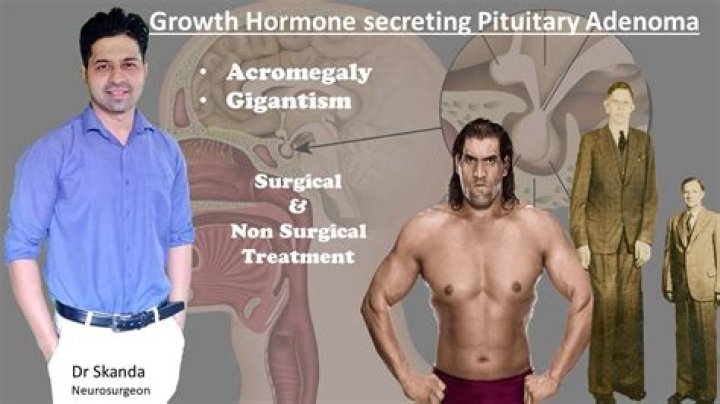What is pituitary gigantism