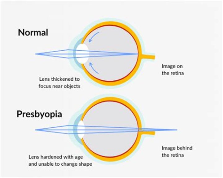 What is presbyopia explain
