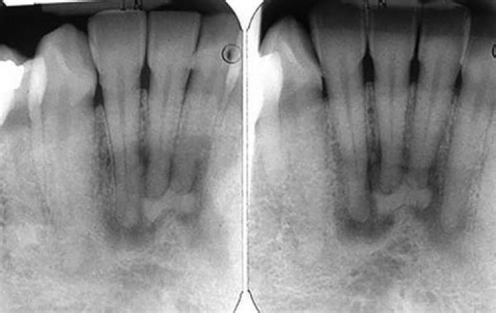 What is Radiolucency in a tooth