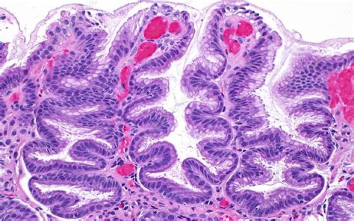 What is reactive Foveolar hyperplasia