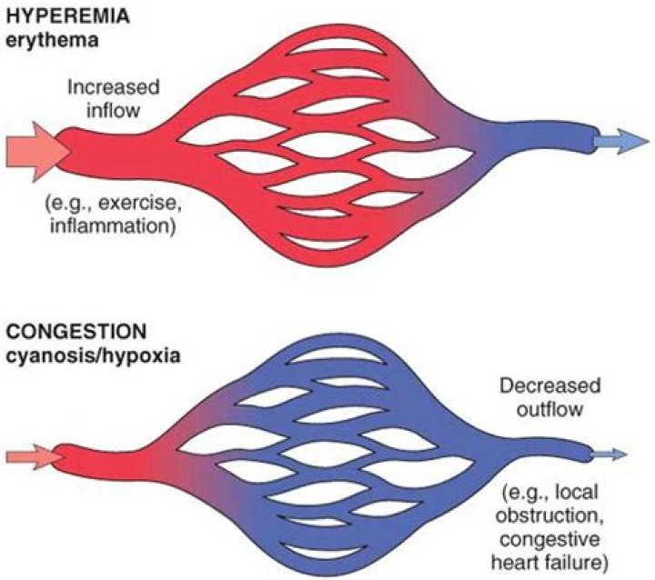 What is reactive Hyperaemia